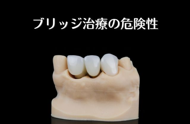 ブリッジ治療の危険性｜高松市で歯を失わない歯科治療なら吉本歯科医院